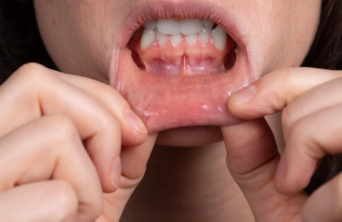 Biopsia de glándula salival menor