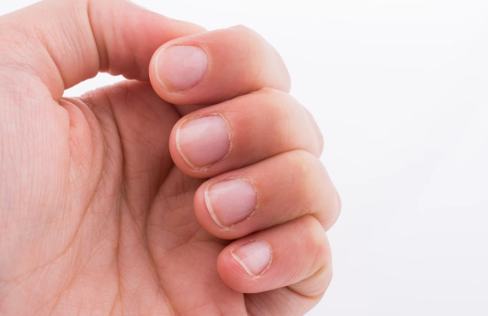 Capilaroscopia del pliegue ungueal